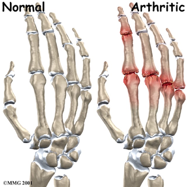 van de vinger: diagnose en behandelingen Orthopedie