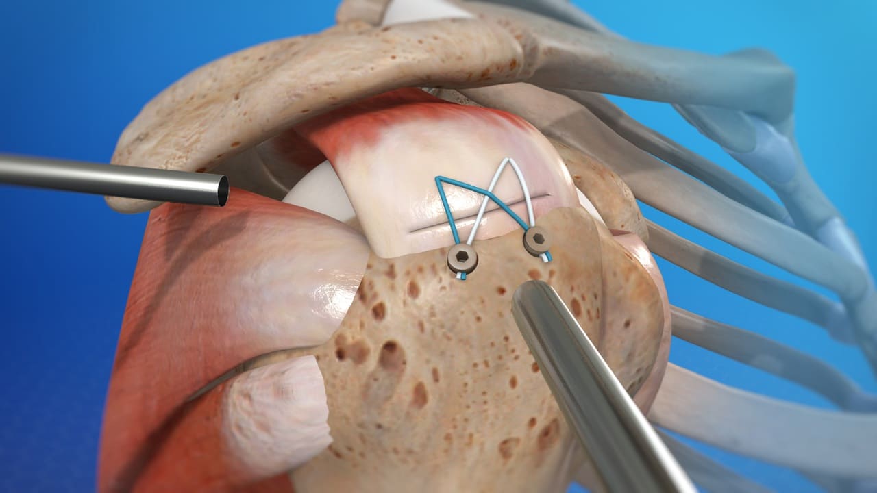 arthroscopisch-rotator-cuff-herstel-orthopedie-traumatologie-mortsel