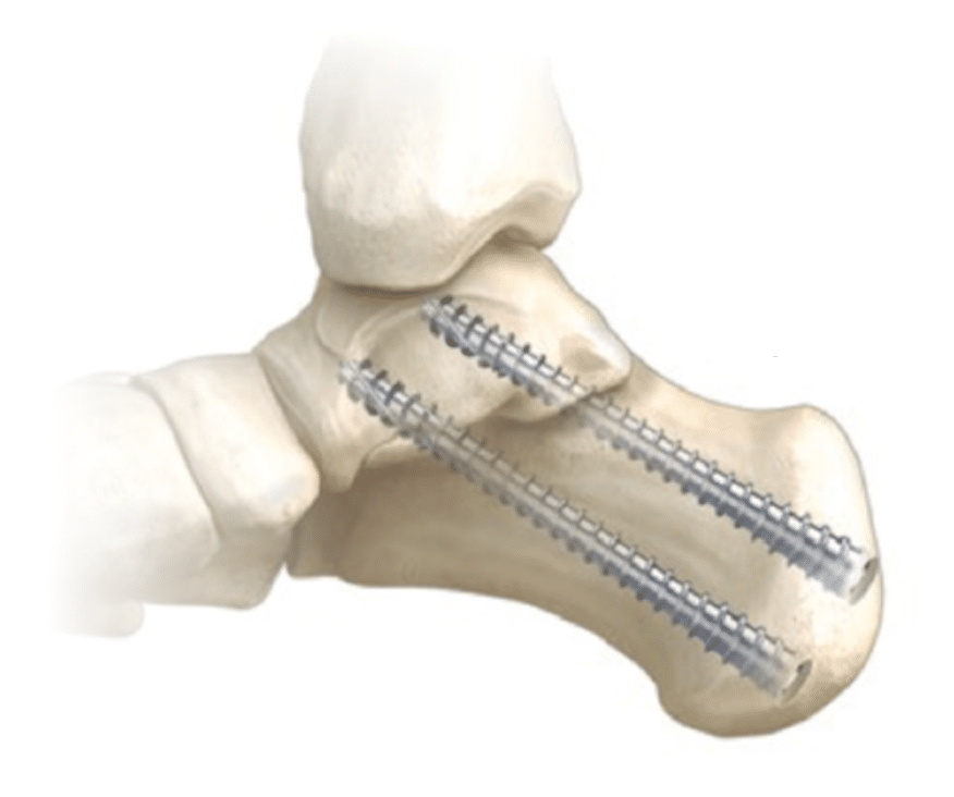 Artroza cauzelor articulare subtalare, Osteoartroza grade a genunchiului